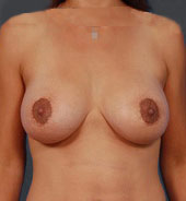 Woman's breasts, after Breast Lift: Benelli treatment, front view, patient 8