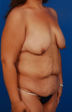 Woman's breasts, before Breast Lift treatment, r-side oblique view, patient 26