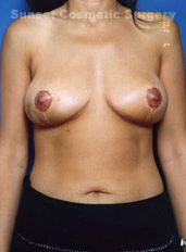 Female breasts, after Breast Lift treatment, front view, patient 4