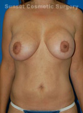 Female breasts, after Breast Lift treatment, front view, patient 7