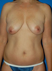 Female breasts, before Breast Lift treatment, front view, patient 7