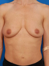Woman's breasts, before Breast Lift treatment, front view, patient 8