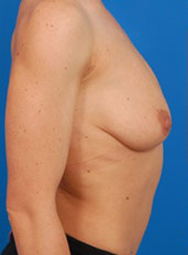 Woman's breasts, before Breast Lift treatment, r-side view, patient 8