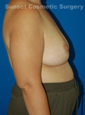 Woman's breasts, after Nipple Reduction treatment, r-side view, patient 2