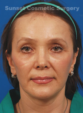 Female face, after Brow Lift, Forehead Lift treatment, front view, patient 4