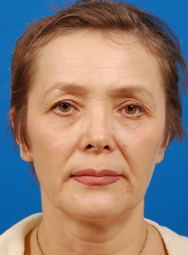 Female face, before Brow Lift, Forehead Lift treatment, front view, patient 4
