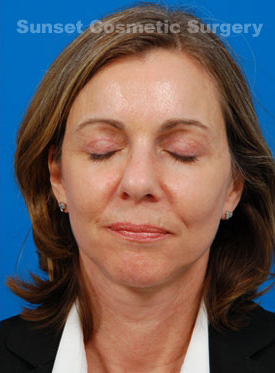 Woman's face, after Brow Lift, Forehead Lift treatment, front view (with closed eyes), patient 8