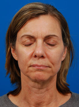 Woman's face, before Brow Lift, Forehead Lift treatment, front view (with closed eyes), patient 8