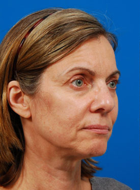 Woman's face, before Brow Lift, Forehead Lift treatment, r-side oblique view, patient 8