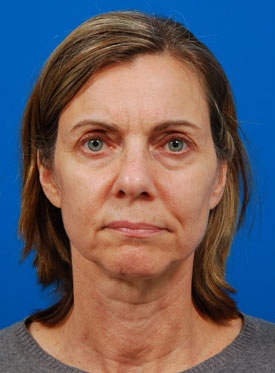 Woman's face, before Brow Lift, Forehead Lift treatment, front view, patient 8