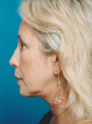 Woman's face, after Brow Lift, Forehead Lift treatment, l-side view, patient 349