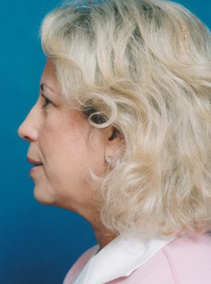Woman's face, before Brow Lift, Forehead Lift treatment, l-side view, patient 349
