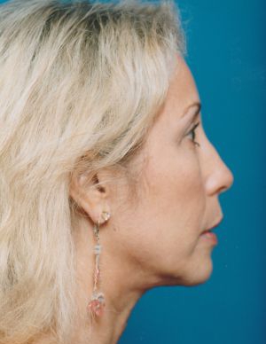 Woman's face, after Brow Lift, Forehead Lift treatment, r-side view, patient 349