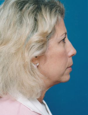 Woman's face, before Brow Lift, Forehead Lift treatment, r-side view, patient 349