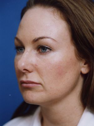 Female face, after Brow Lift, Forehead Lift treatment, l-side oblique view, patient 8