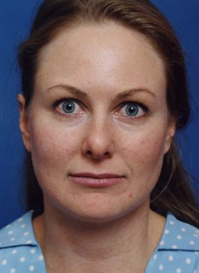 Female face, before Brow Lift, Forehead Lift treatment, front view, patient 8