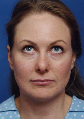 Female face, before Brow Lift, Forehead Lift treatment, front view (eyes looks up), patient 8