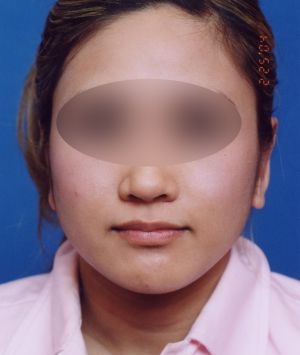 Woman's face, after Ear Surgery (Otoplasty) treatment, front view of head, patient 10