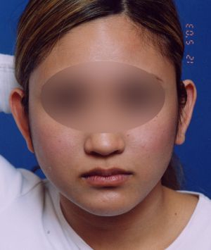 Woman's face, before Ear Surgery (Otoplasty) treatment, front view of head, patient 10