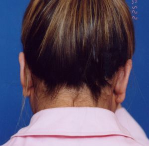 Woman's face, after Ear Surgery (Otoplasty) treatment, back side view of head, patient 10