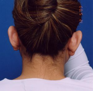 Woman's face, before Ear Surgery (Otoplasty) treatment, back side view of head, patient 10