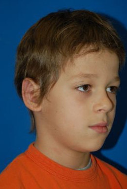 Children head, after Ear Surgery (Otoplasty) treatment, oblique view (right ear), patient 11