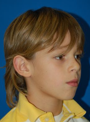 Children head, before Ear Surgery (Otoplasty) treatment, oblique view (right ear), patient 11