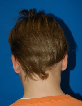 Children head, after Ear Surgery (Otoplasty) treatment, back side view (left ear), patient 11