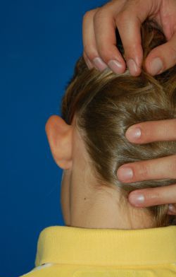 Children head, before Ear Surgery (Otoplasty) treatment, back side view (left ear), patient 11