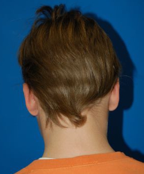 Children head, after Ear Surgery (Otoplasty) treatment, back side view (right ear), patient 11