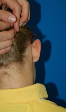 Children head, before Ear Surgery (Otoplasty) treatment, back side view (right ear), patient 11