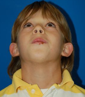 Children head, before Ear Surgery (Otoplasty) treatment, front view (bend over), patient 11