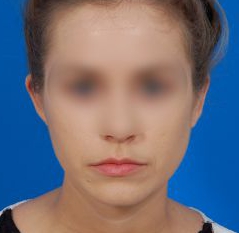 Woman's face, after Ear Surgery (Otoplasty) treatment, front view of head, patient 12