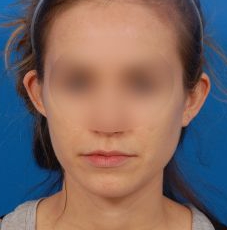 Woman's face, before Ear Surgery (Otoplasty) treatment, front view of head, patient 12