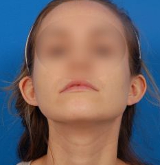 Woman's face, before Ear Surgery (Otoplasty) treatment, front view of head (bend over), patient 12
