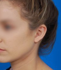 Woman's face, after Ear Surgery (Otoplasty) treatment, l-side oblique view of head, patient 12