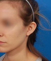 Woman's face, before Ear Surgery (Otoplasty) treatment, l-side oblique view of head, patient 12