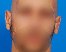 Male face, after Ear Surgery (Otoplasty) treatment, front view of head, patient 13