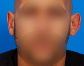 Male face, before Ear Surgery (Otoplasty) treatment, front view of head, patient 13
