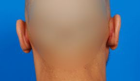 Male face, after Ear Surgery (Otoplasty) treatment, back side view of head, patient 13