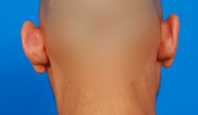 Male face, before Ear Surgery (Otoplasty) treatment, back side view of head, patient 13