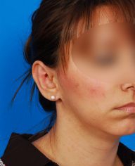 Woman's face, after Ear Surgery (Otoplasty) treatment, r-side oblique view, patient 14