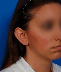 Woman's face, before Ear Surgery (Otoplasty) treatment, r-side oblique view, patient 14