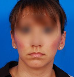 Woman's face, after Ear Surgery (Otoplasty) treatment, front view, patient 14