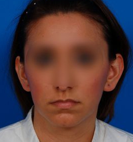 Woman's face, before Ear Surgery (Otoplasty) treatment, front view, patient 14