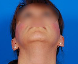 Woman's face, after Ear Surgery (Otoplasty) treatment, front view (bend over), patient 14