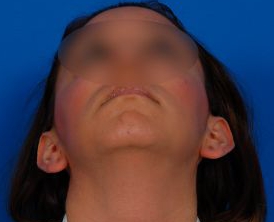 Woman's face, before Ear Surgery (Otoplasty) treatment, front view (bend over), patient 14