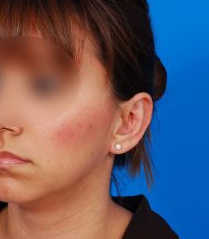Woman's face, after Ear Surgery (Otoplasty) treatment, l-side oblique view, patient 14