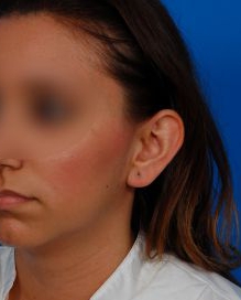 Woman's face, before Ear Surgery (Otoplasty) treatment, l-side oblique view, patient 14