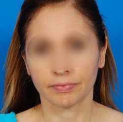 Woman's face, after Ear Surgery (Otoplasty) treatment, front view, patient 15